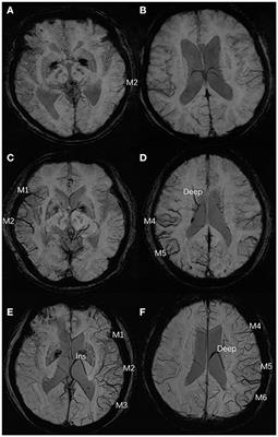 Cortical Venous Changes on Susceptibility-Weighted Imaging Predict the Cerebral Collateral Circulation as Confirmed by Digital Subtraction Angiography